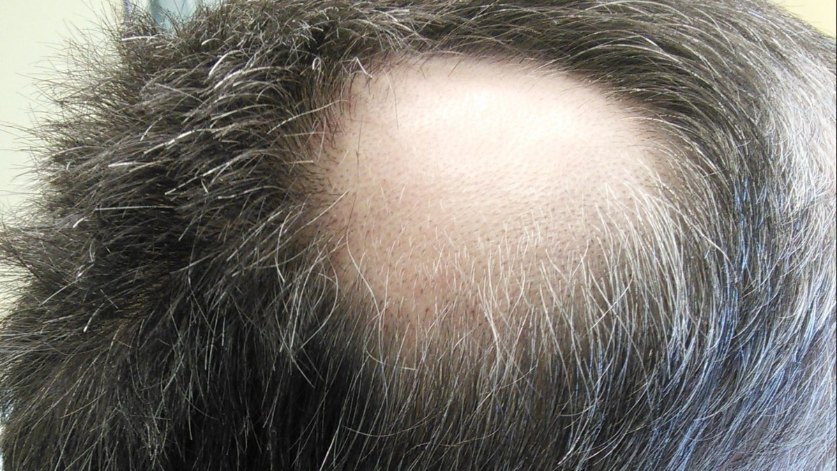 5 Reasons Your Hair Is Thinning