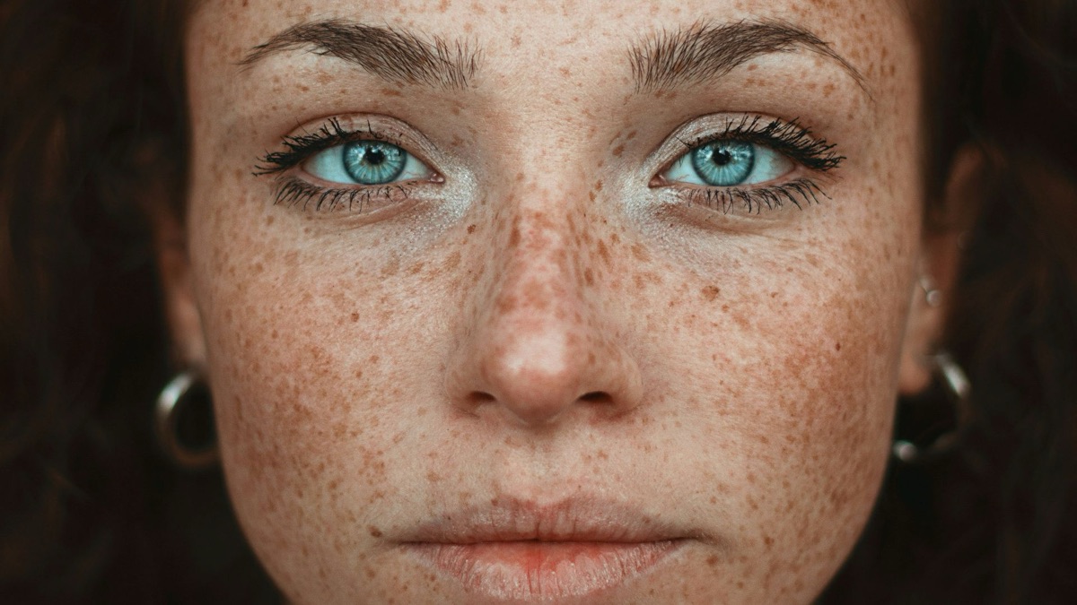 5 Remedies That Effectively Treat Hyperpigmentation